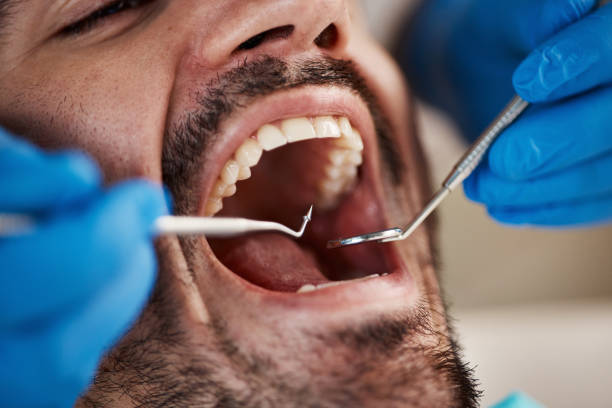 Best Emergency Dentist for Lost Fillings or Crowns in Oxoboxo River, CT